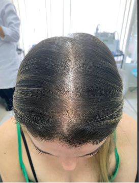 Antes